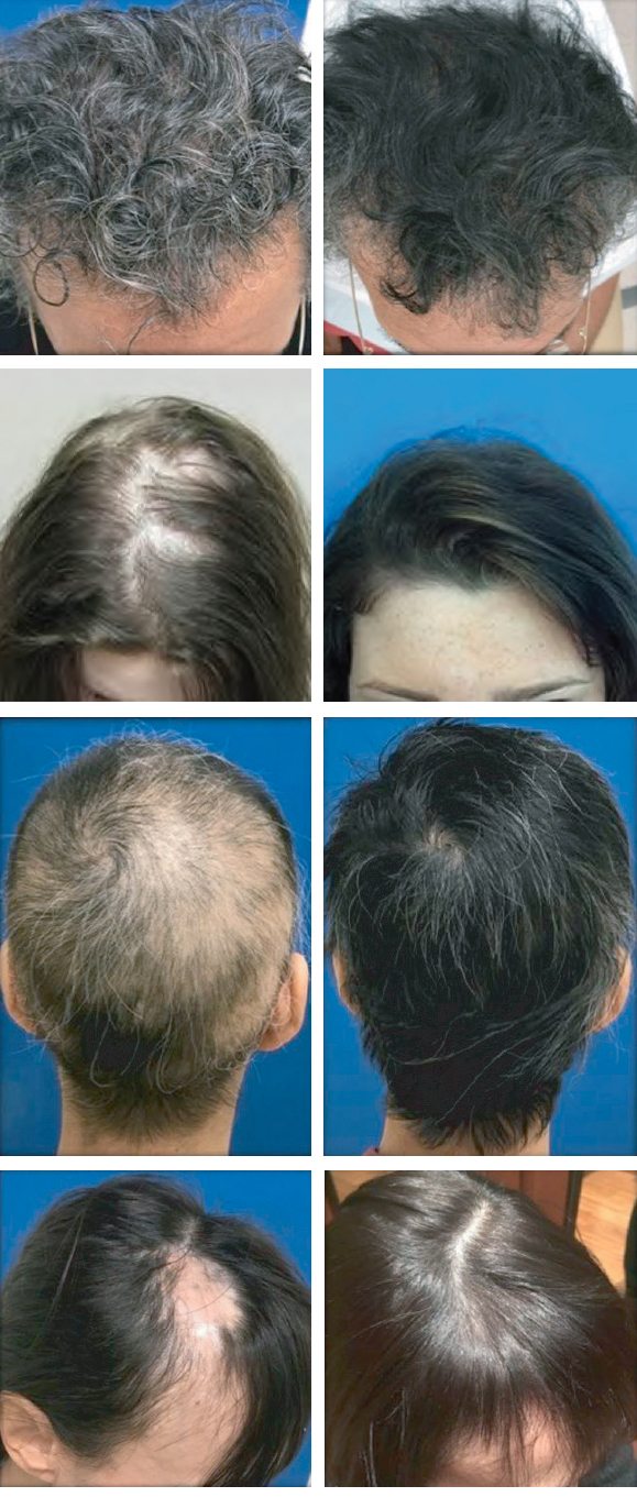 PRP Hair Loss Restoration